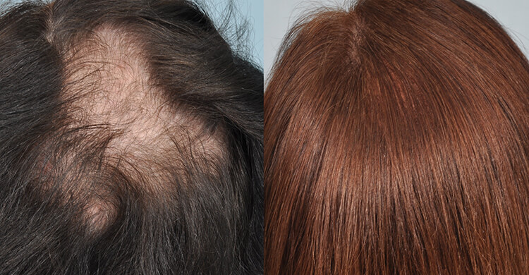 Long Hair Transplantation Lht Treatment Pune India long hair transplantation lht
