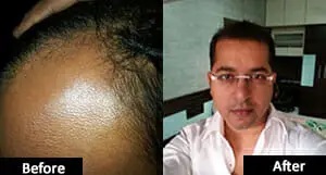 Hair Transplant Clinic Pune
